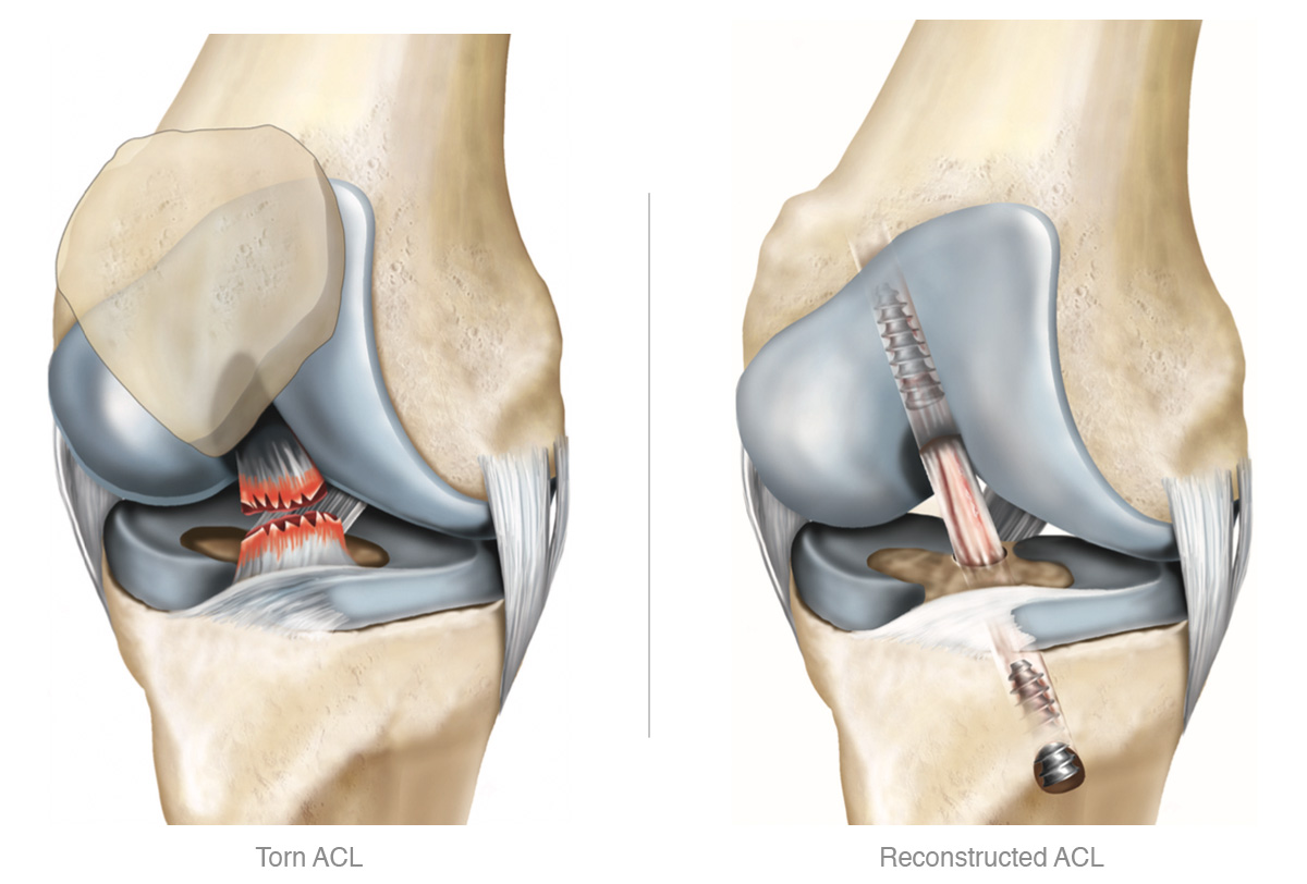 image showing anatomy of the anterior cruciate ligament (ACL) showing a torn anterior cruciate ligament and and a reconstructed ligament